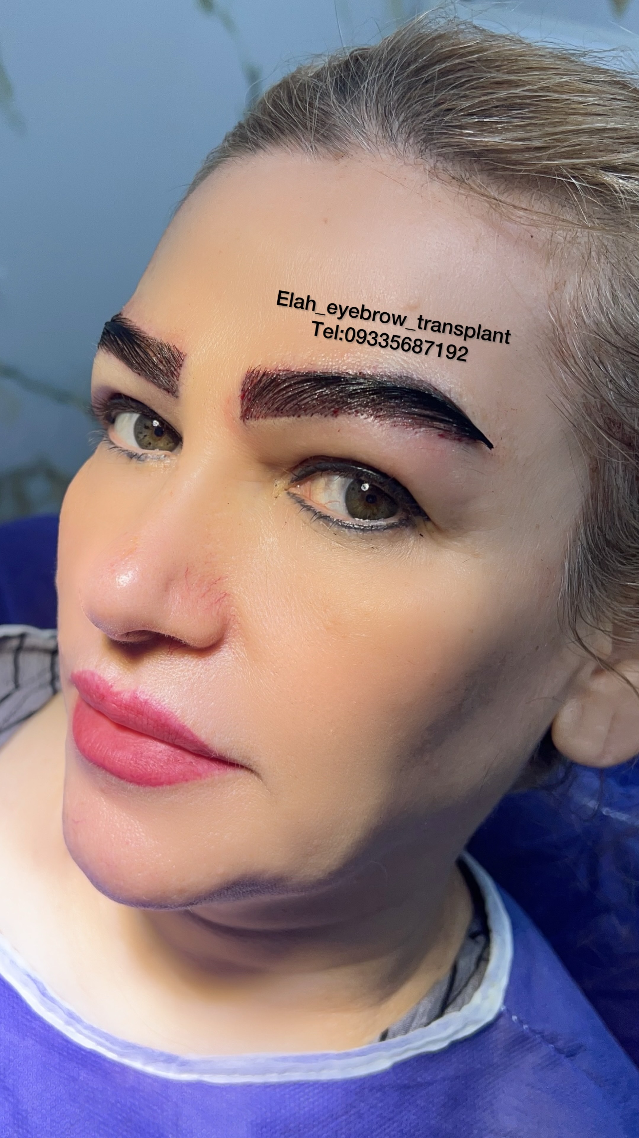 کاشت ابرو الی راز