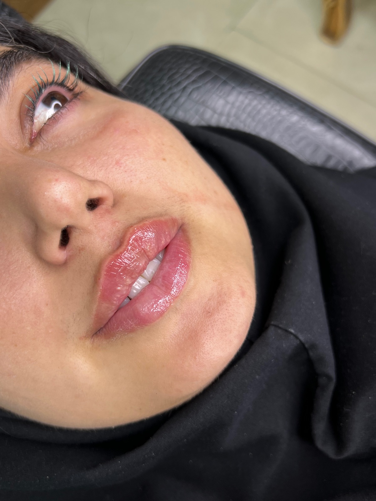 تزریق فیلر و‌بوتاکس چالوس