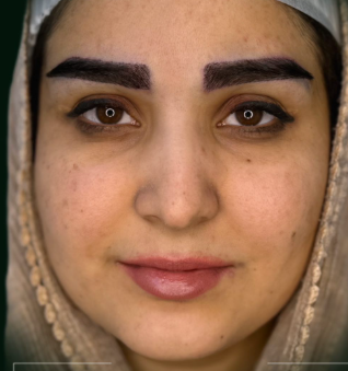 کاشت ابرو شادی حسینی