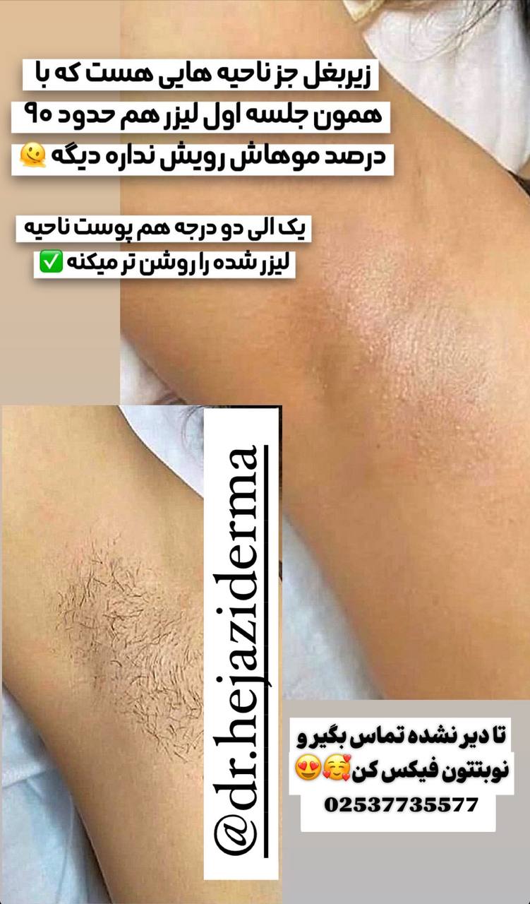 مرکز لیزر مو های زائد کندلا دکتر حجازی