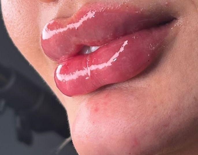 خدمات ژل وبوتاکس