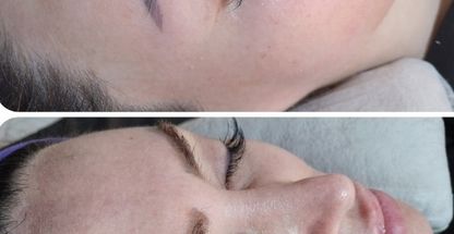 فیشیال تخصصی  پوست کاشانی