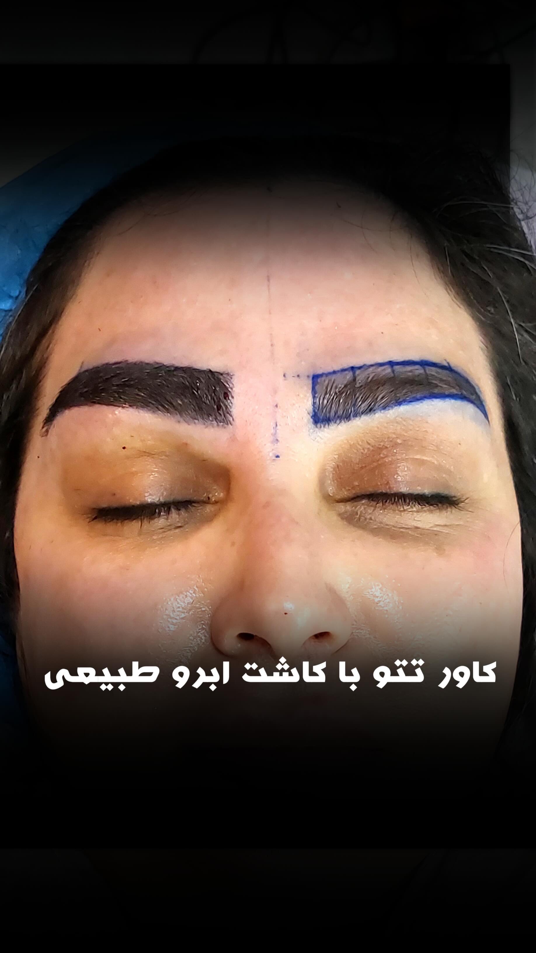 مرکز تخصصی کاشت مو و ابرو بهبد کرج