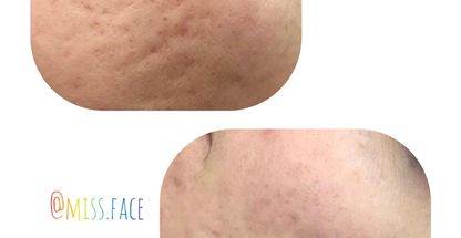 پاکسازی پوست بانوانmissFace