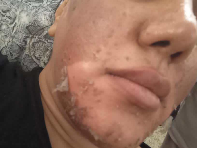 پاکسازی پوست میرزایی