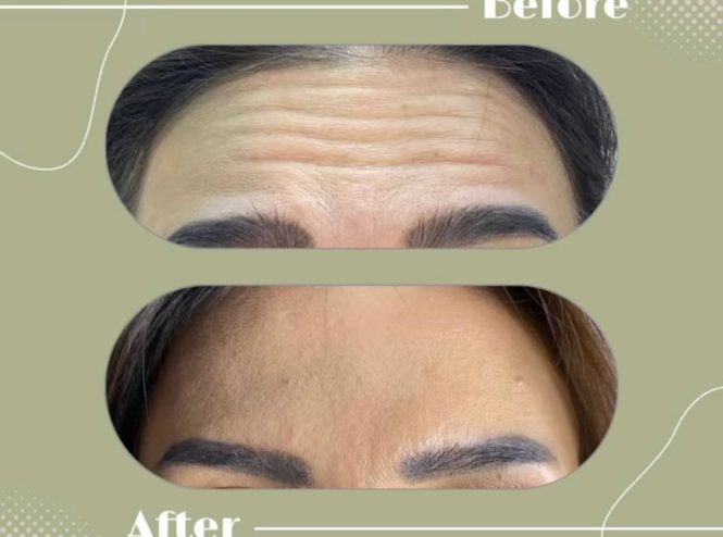 لیزر و زیبایی دانژه