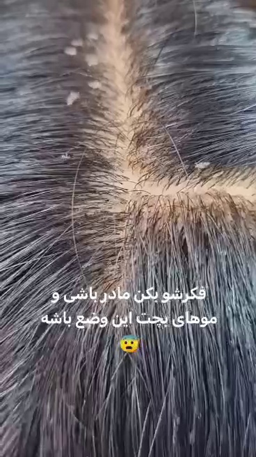 مرکز درمان شپش  آریافر