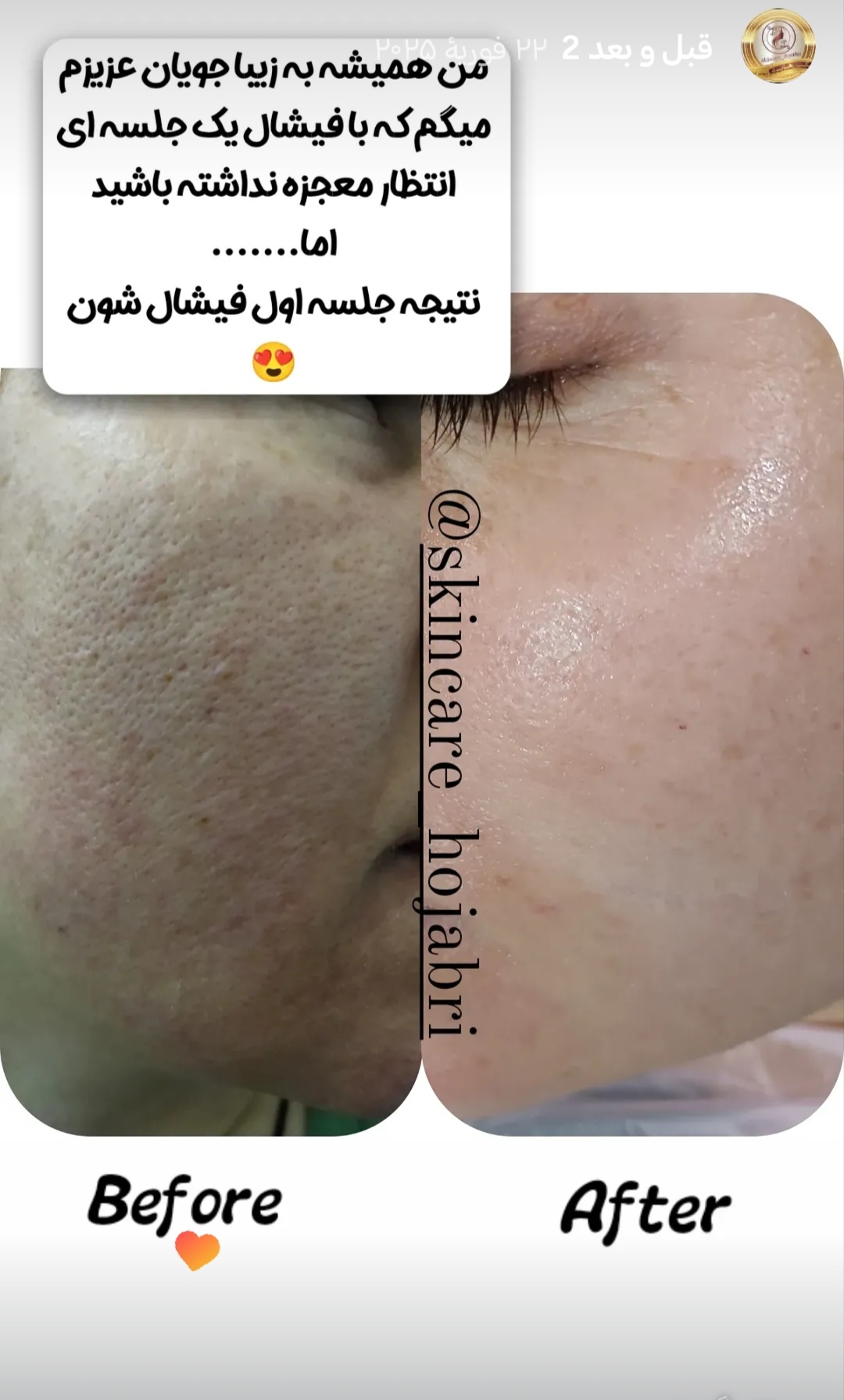 پاکسازی صورت فیشال تخصصی بانو