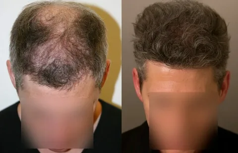 کلینیک کاشت مو و ابرو دکتر بصیری