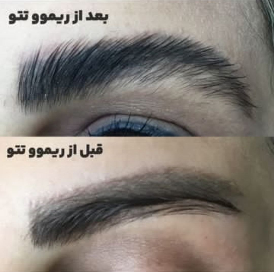 خدمات تخصصی ریموو  تتوی قدیمی
