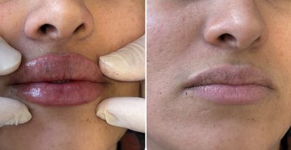 هایفو، فشیال، اسکالپ دکتر علی اکبری