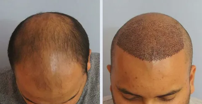 کلینیک کاشت ابرو و مو بهین