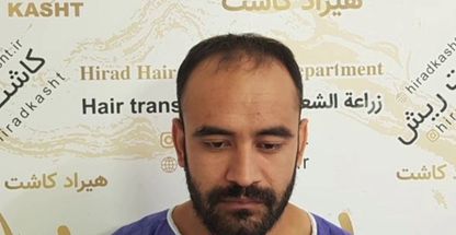 دپارتمان تخصصی کاشت مو کاشت ابرو هیراد