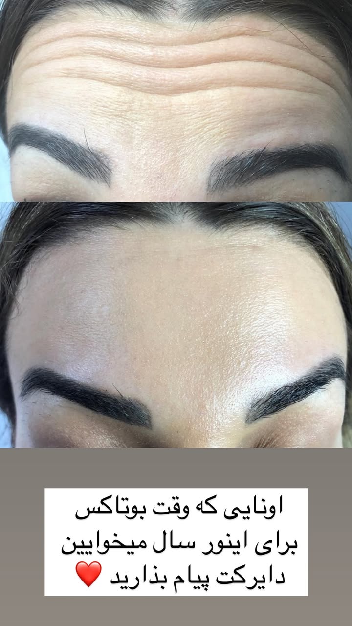 پوست و زیبایی ژل بوتاکس خالبرداری و غیره