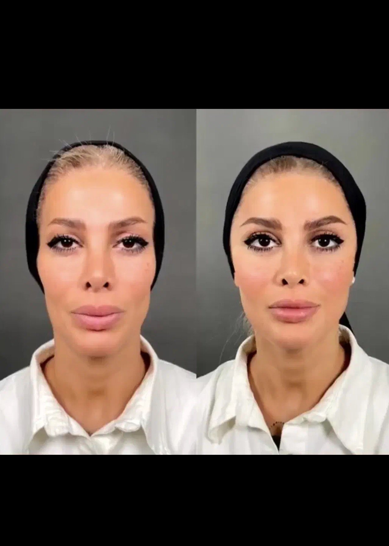 خدمات تخصصی ژل بوتاکس لیزر فیل بیوتی