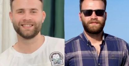 کاشت مو جانا