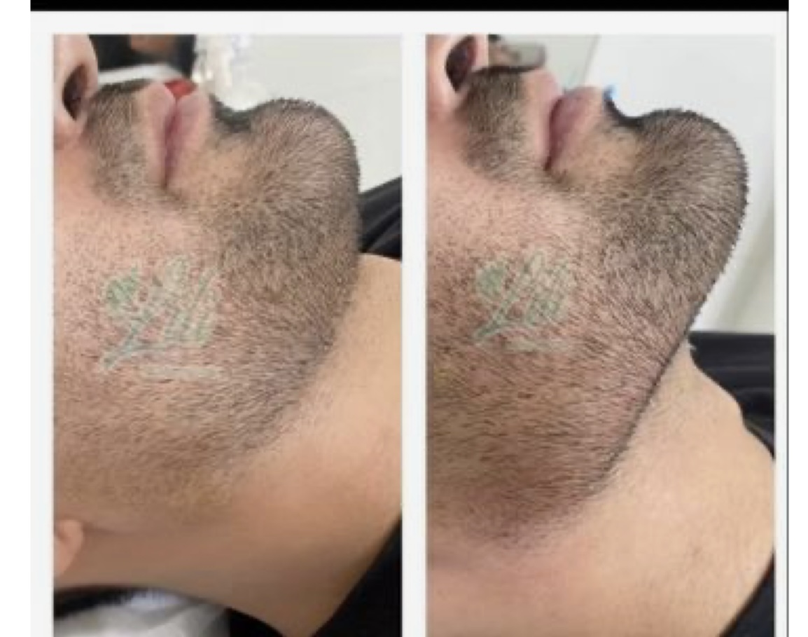 تزریق ژل و بوتاکس عبداله کوخی