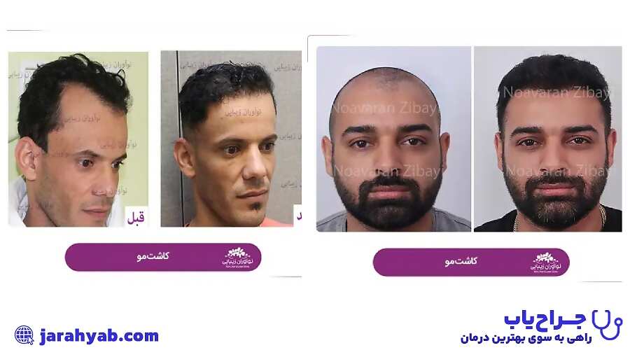 کلینیک کاشت مو نوآوران زیبایی (Noavarane Zibayi Clinic)