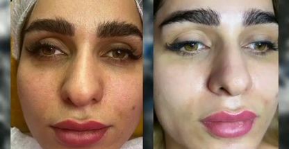 پاکسازی و جوانسازی پوست و فیشال فرلی