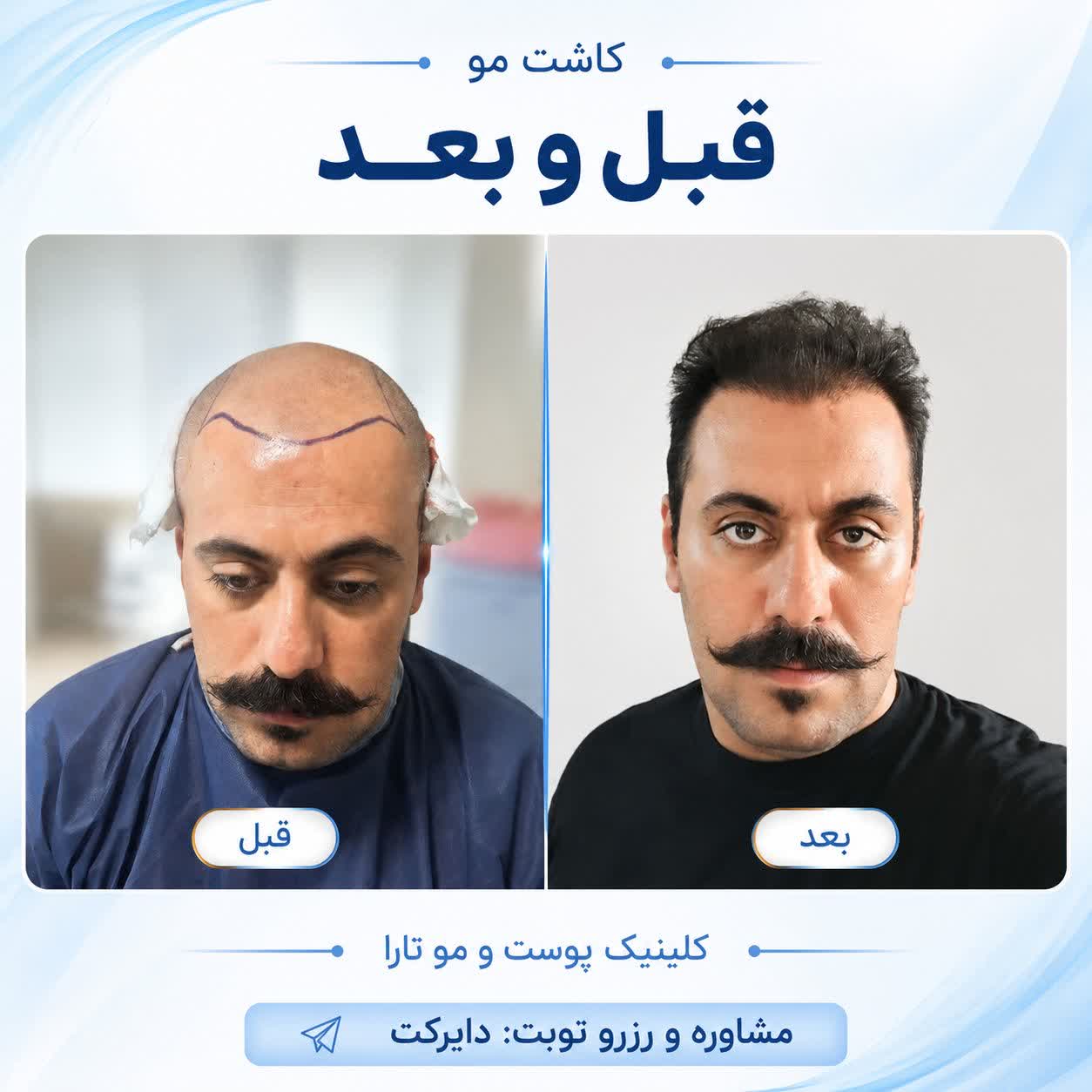 کاشت مو و ابرو
