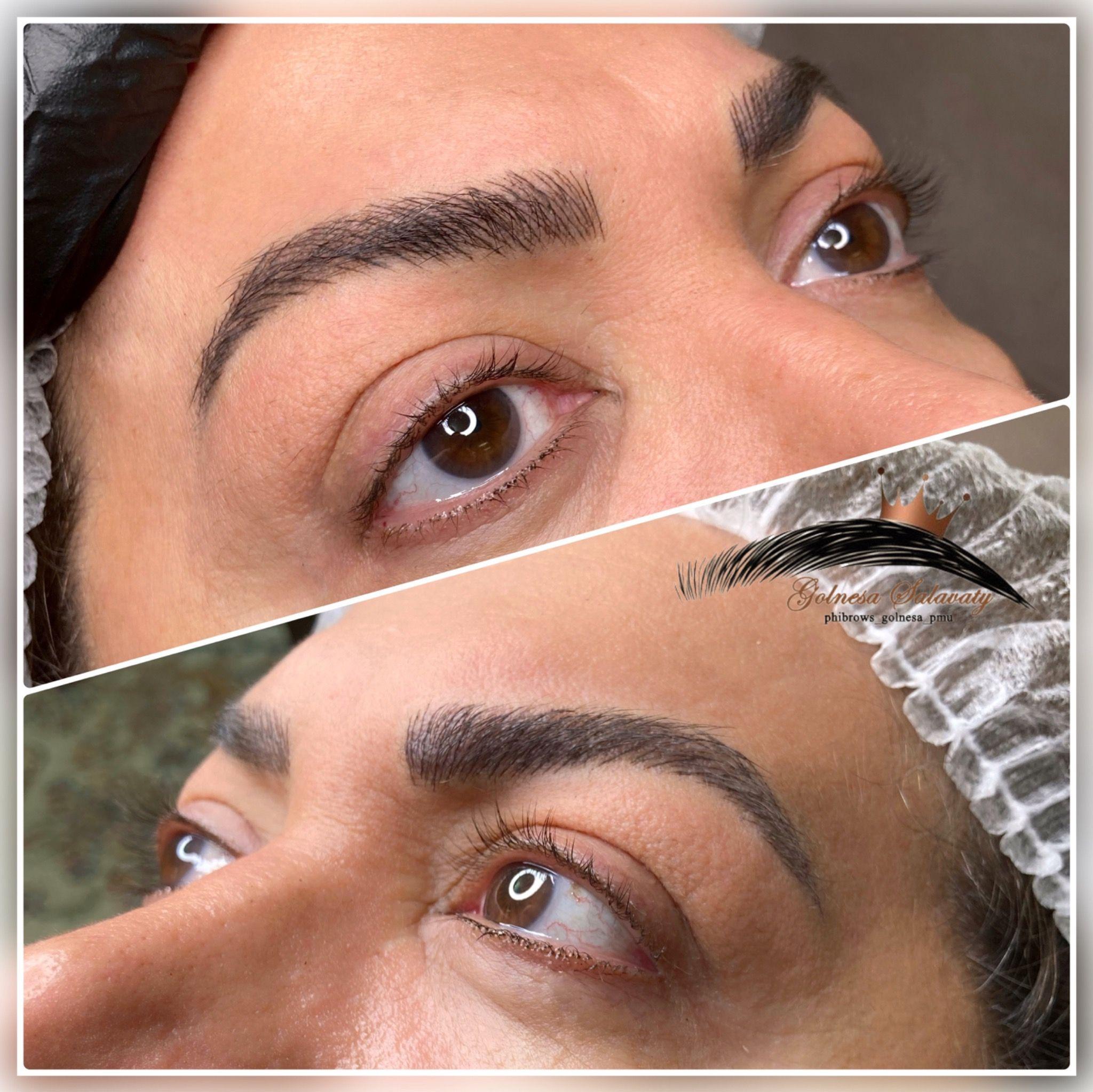 میکروبلیدینگ میکروپیگمنیشن و ریمو گلنسا