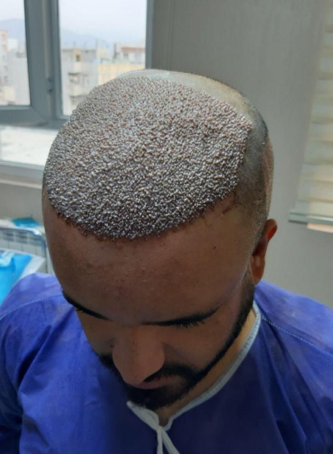 کاشت مو تبریز سونیتا