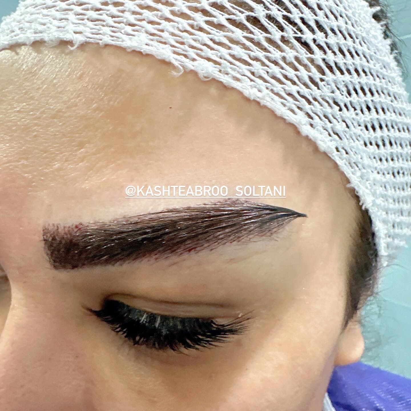 کاشت ابرو سلطانی متد پنج زاویه