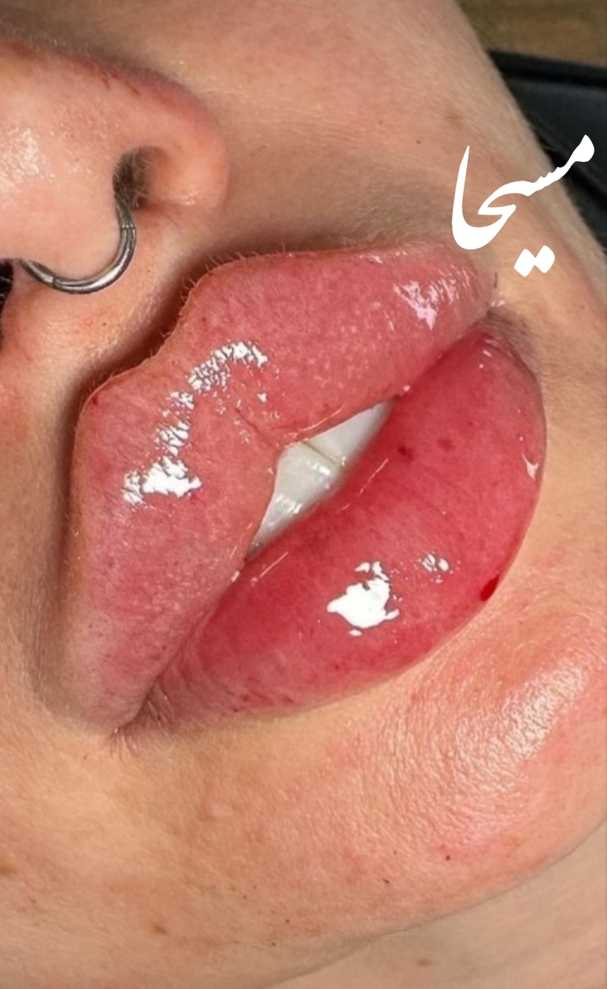 تزریق بوتاکس مسیحا