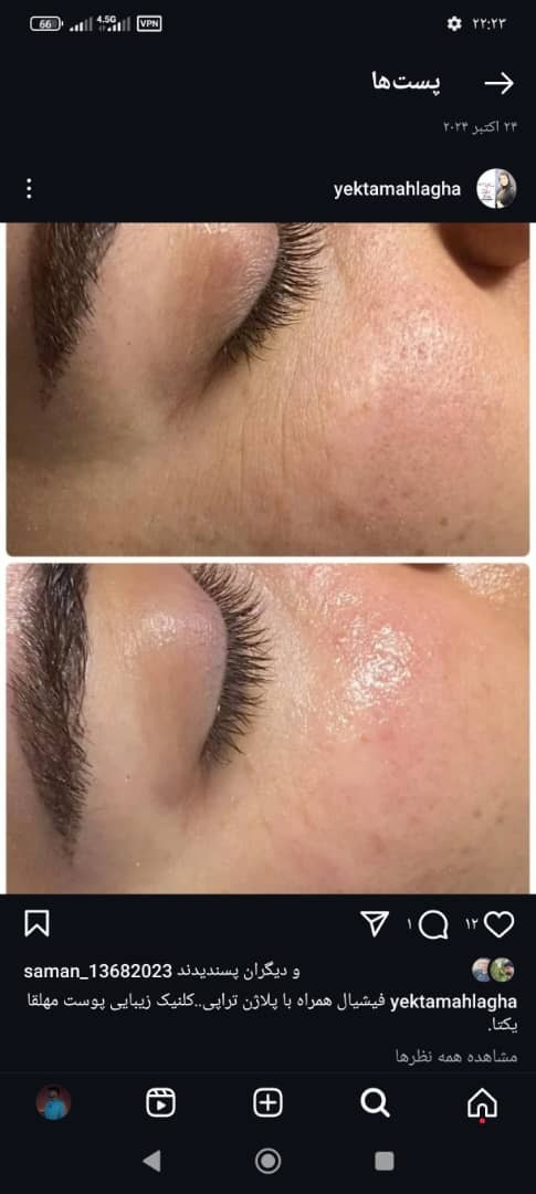 تزریق ژل و بوتاکس یکتا