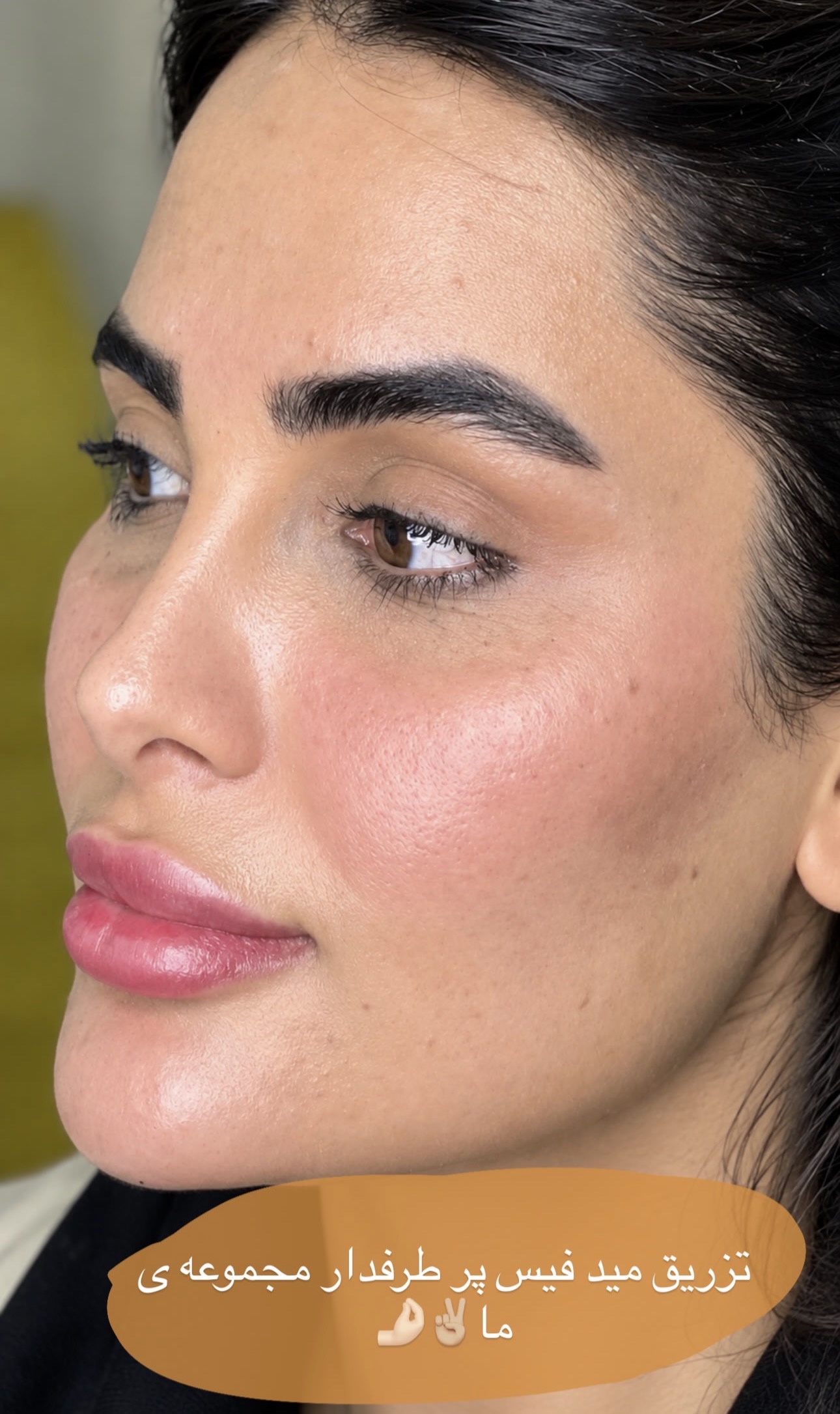 فیلر لب و مادلینک صورت