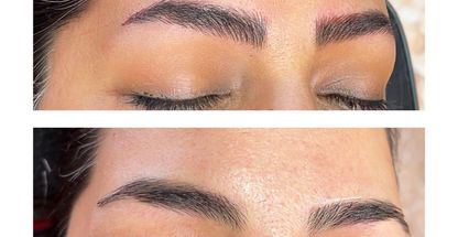 میکروبلیدینگ فیبروزکرمان