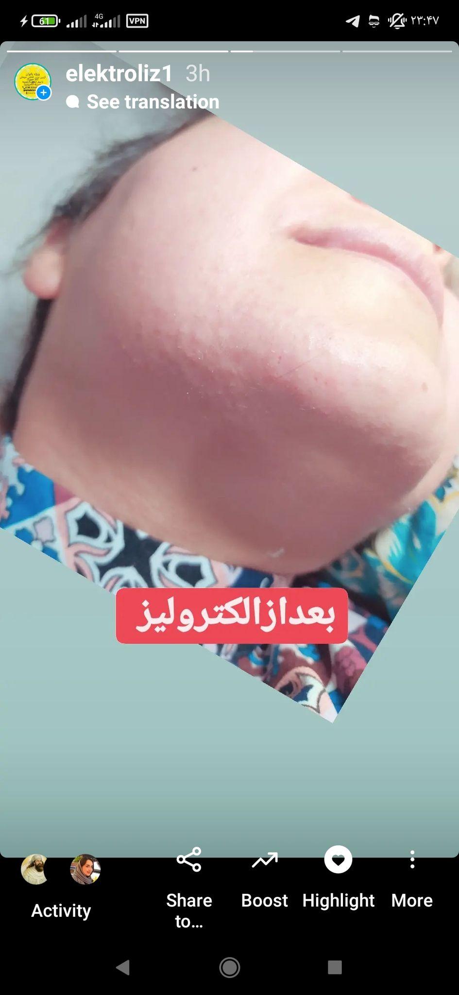 متخصص الکترولیزورفع دائمی صورت بانوان