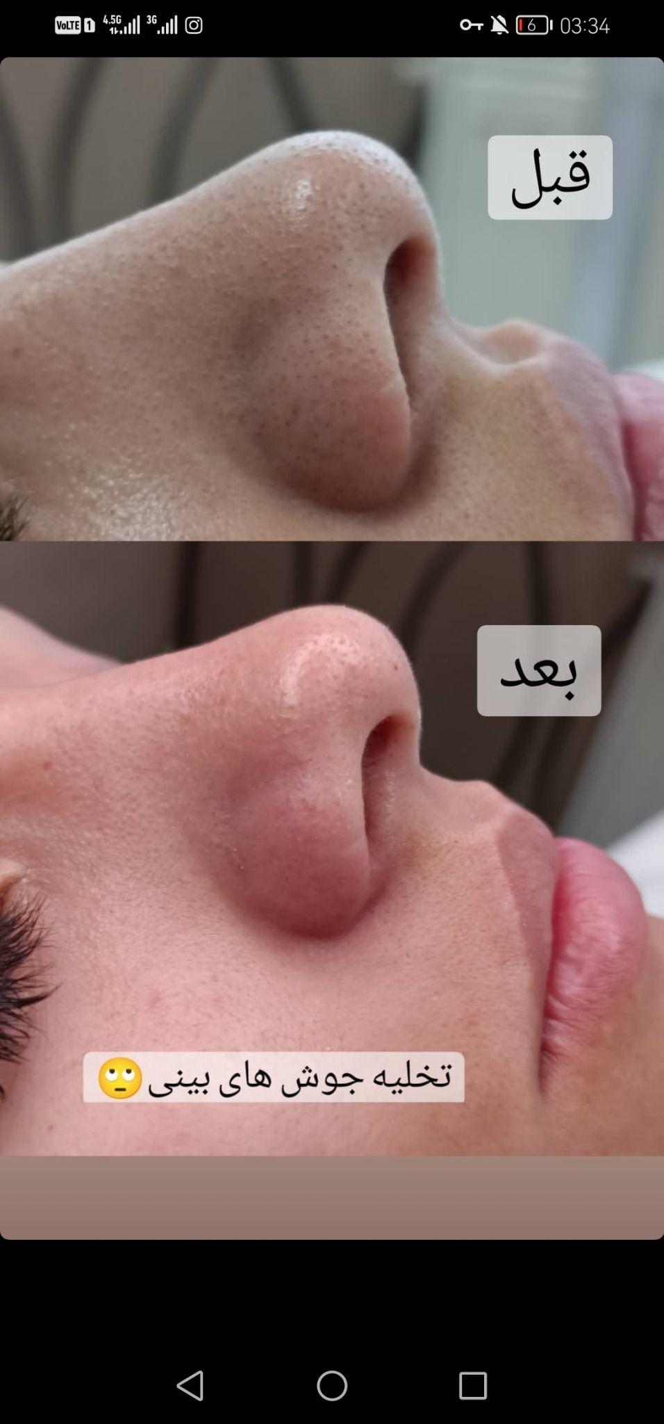 پاکسازی پوست النا