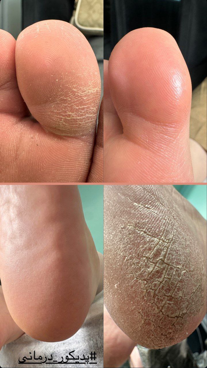 پدیکور و کفسابی تخصصی نیلوفر