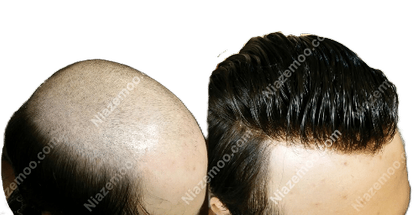 پروتزمو و خدمات پروتزمو