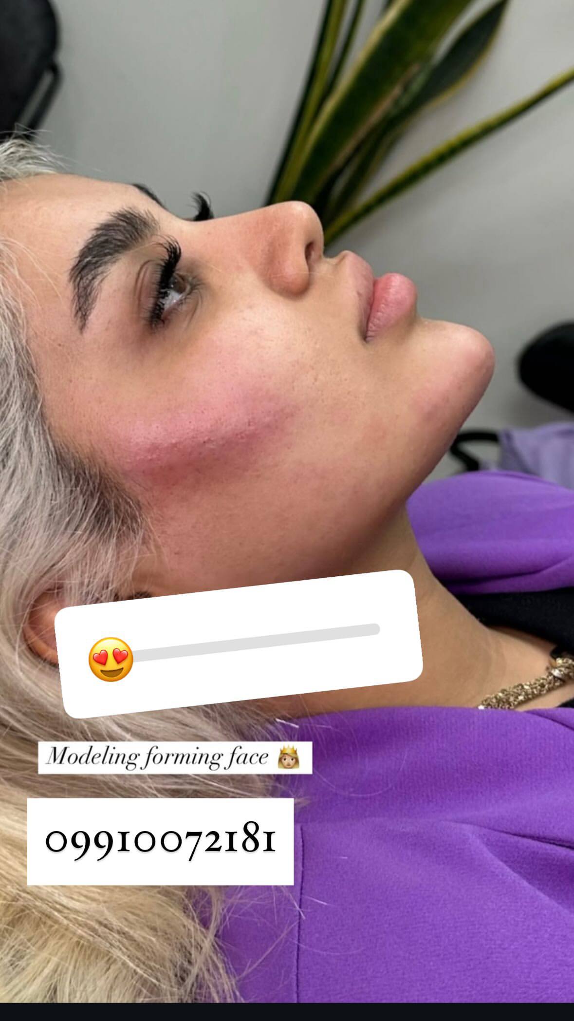 ژل و بوتاکس مونالیزا