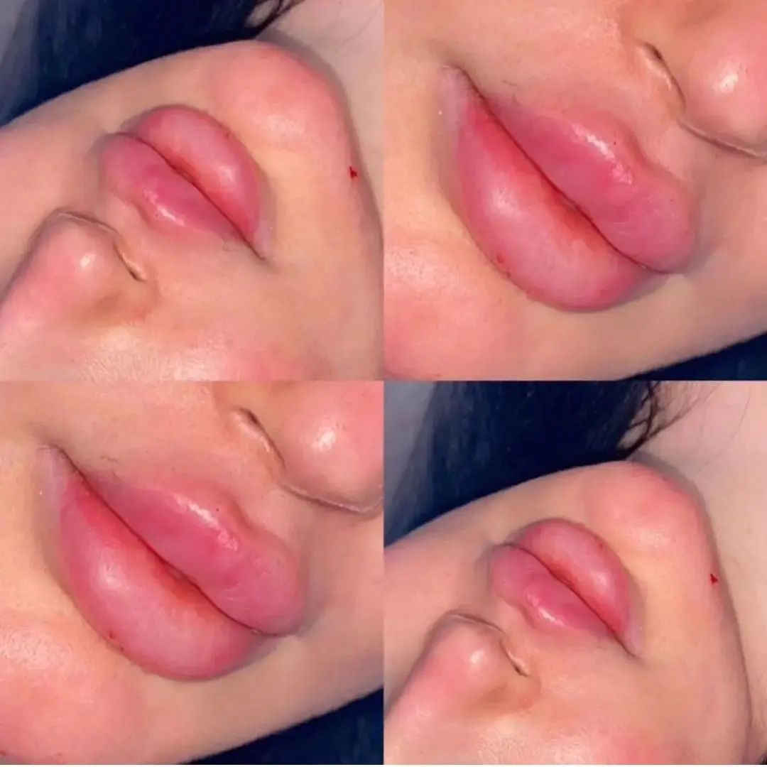 ژل بوتاکس تزریق فیلر صورت و بدن