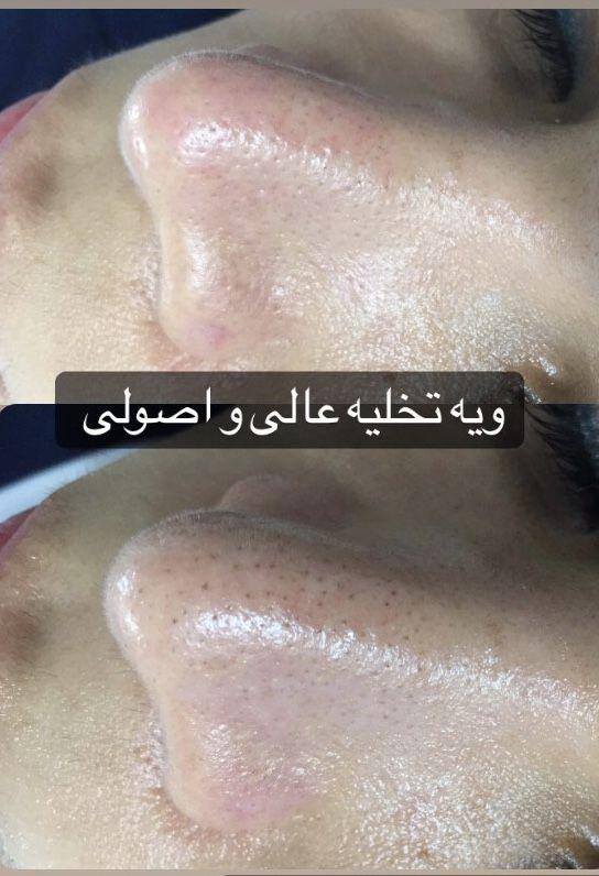 فیشال وپاکسازی پوست