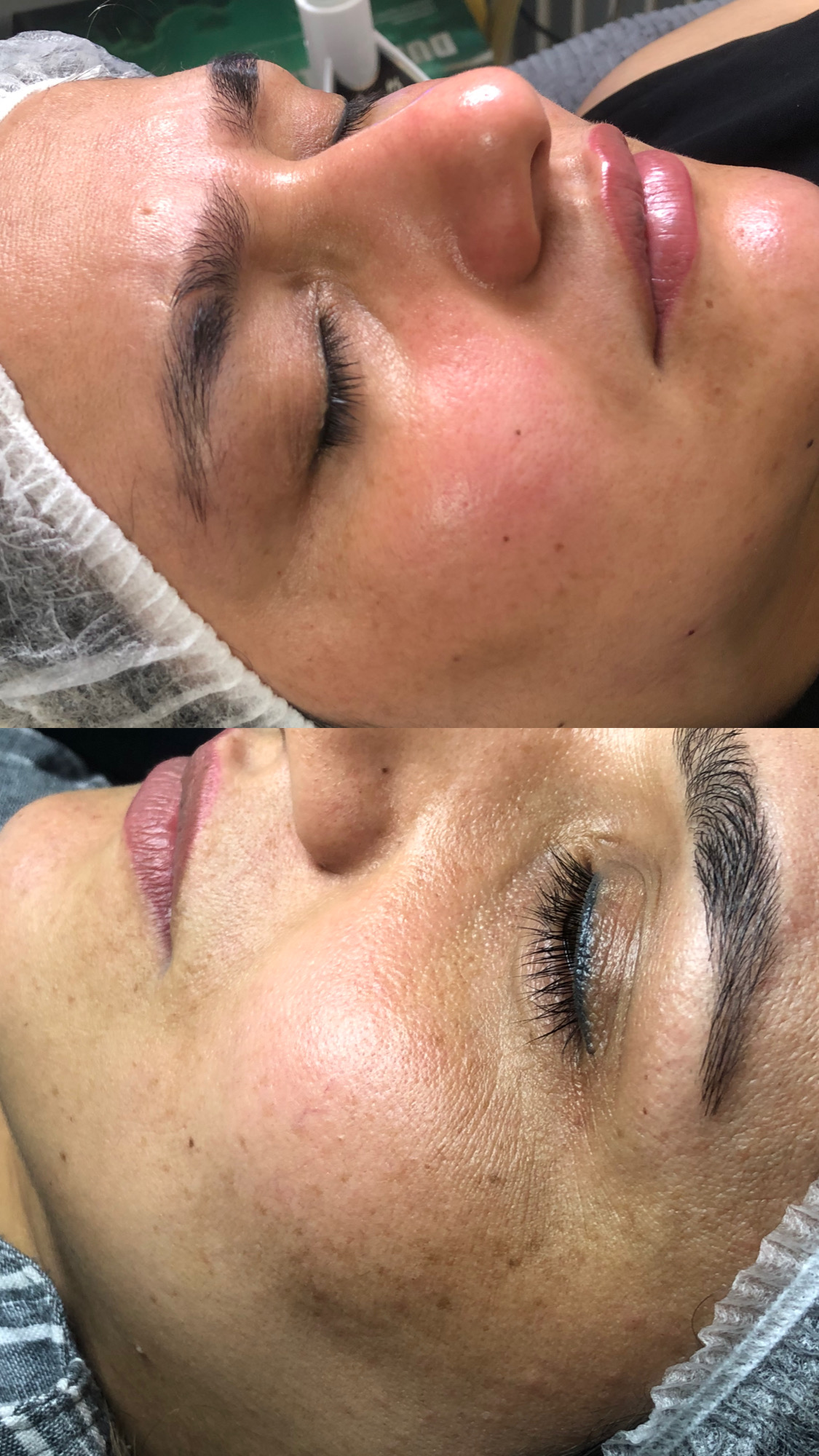 خدمات تخصصی پاکسازی و فیشال پوست