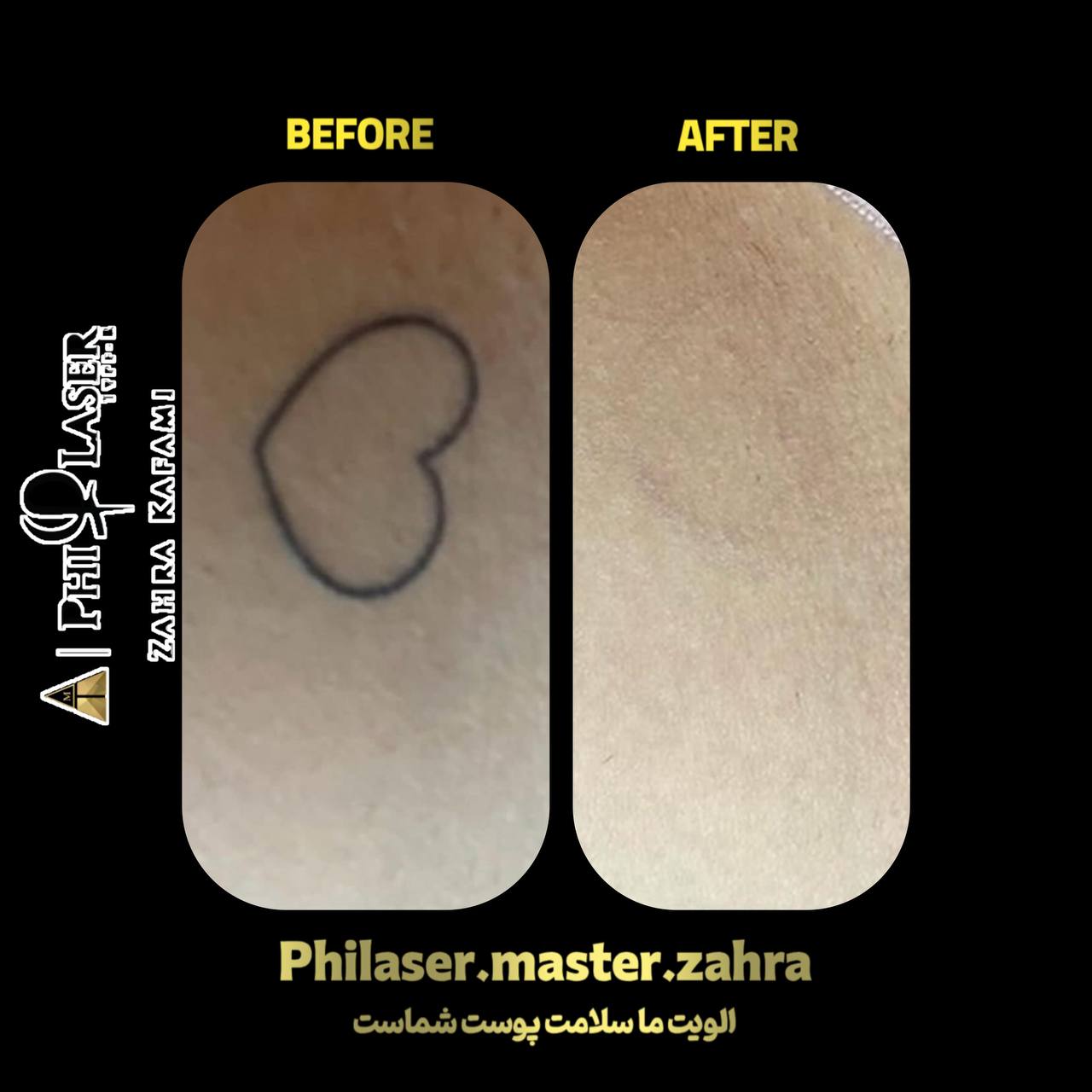 مرکز تخصصی لیزر تتو زهرا کفعمی