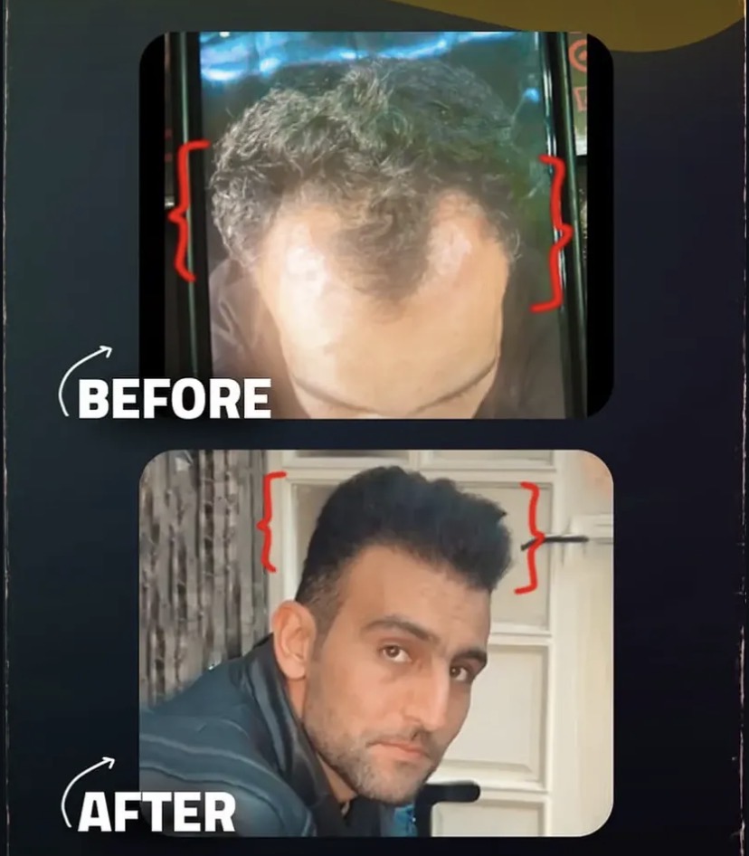 کلینیک کاشت مو زمرد