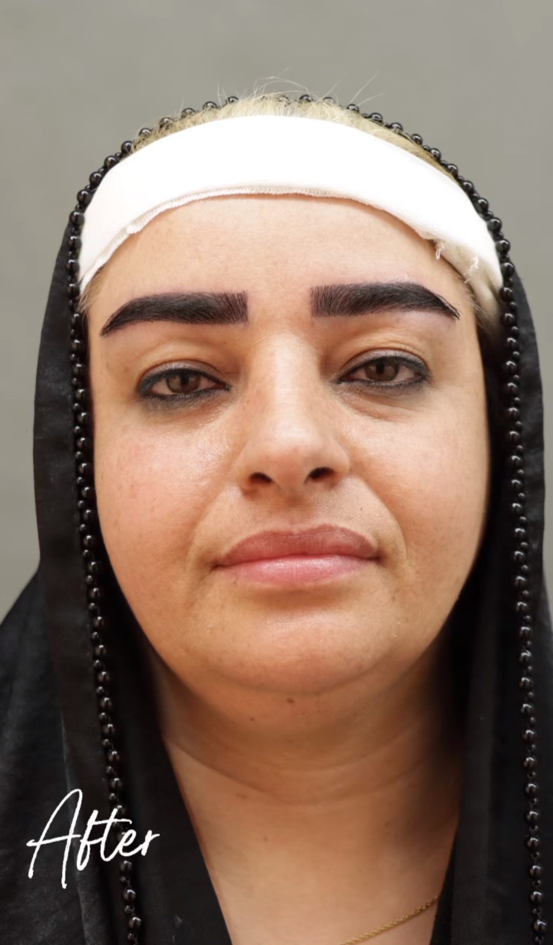 کاشت مو و ابرو متولی