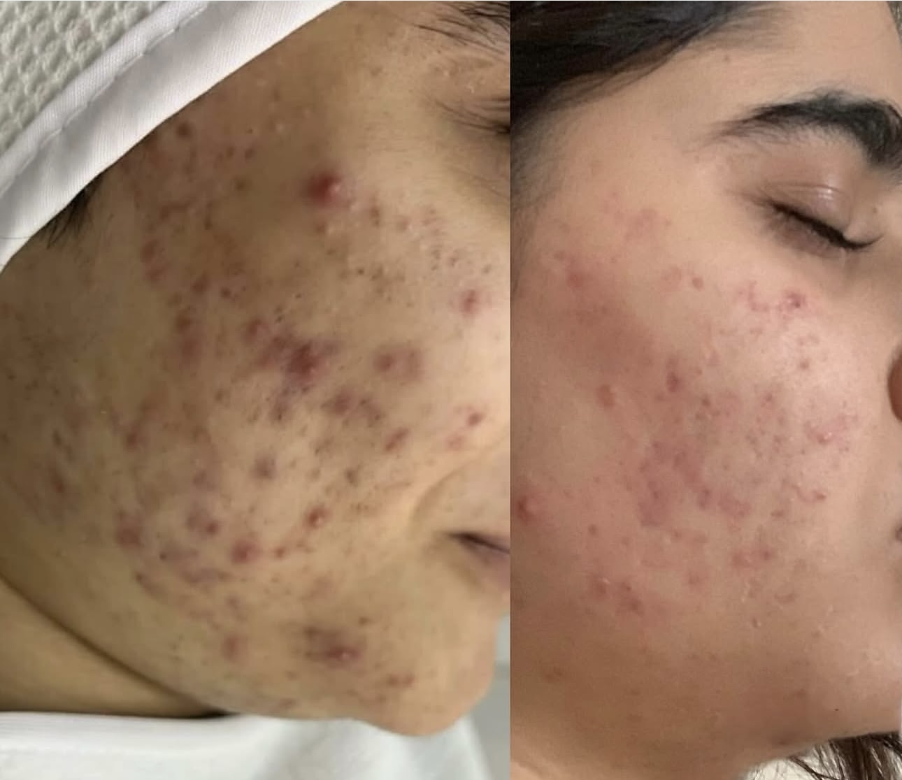 فیشیال و پاکسازی پوست حانیه