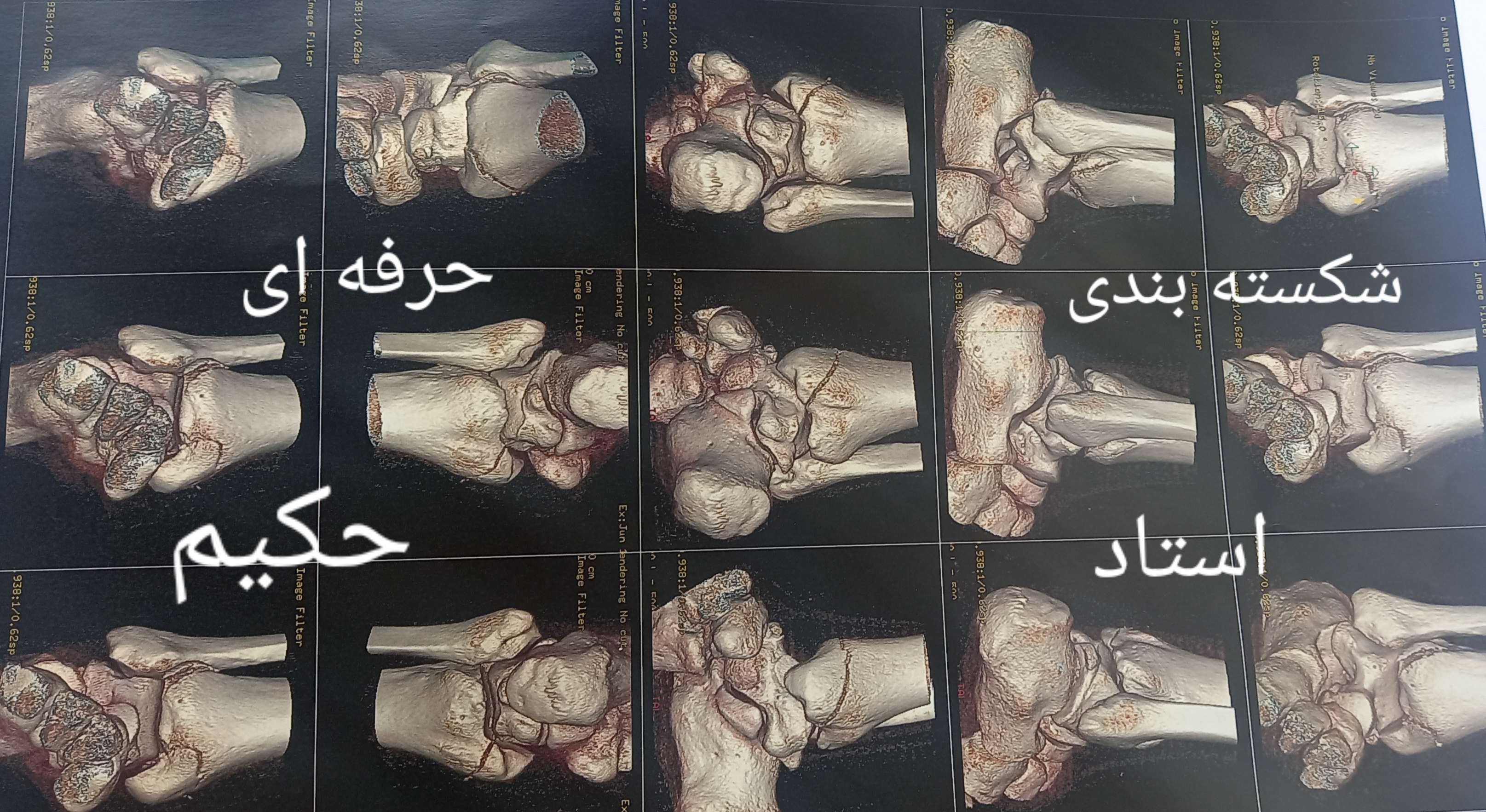 شکسته بندی، طب سنتی استادحکیم