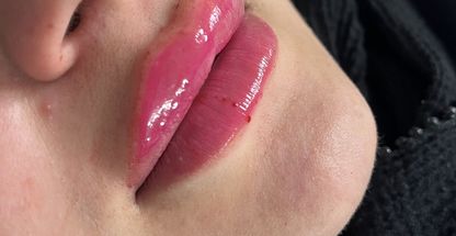 تزریق ژل و بوتاکس مهسا