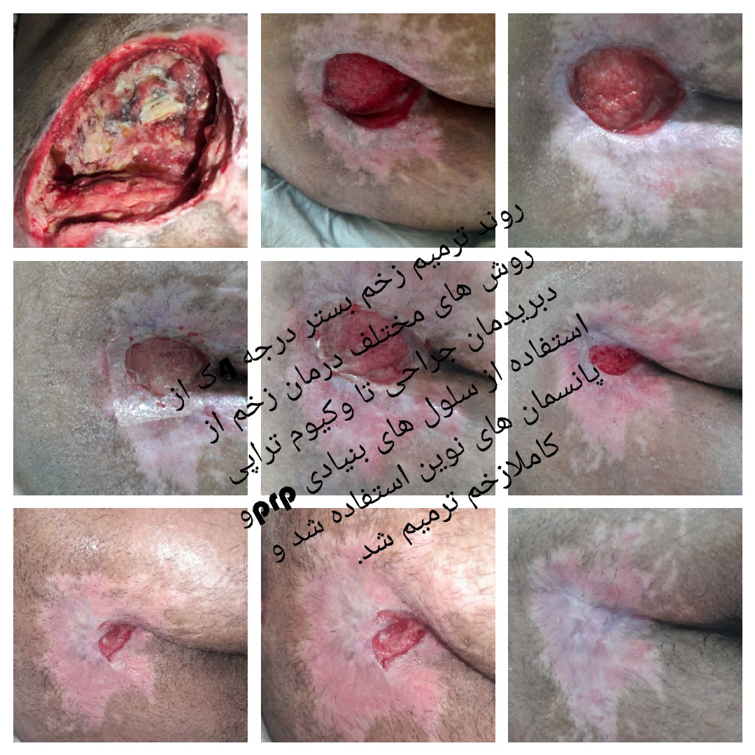 کارشناس زخم و متخصص کیوم تراپی بهرامی فر