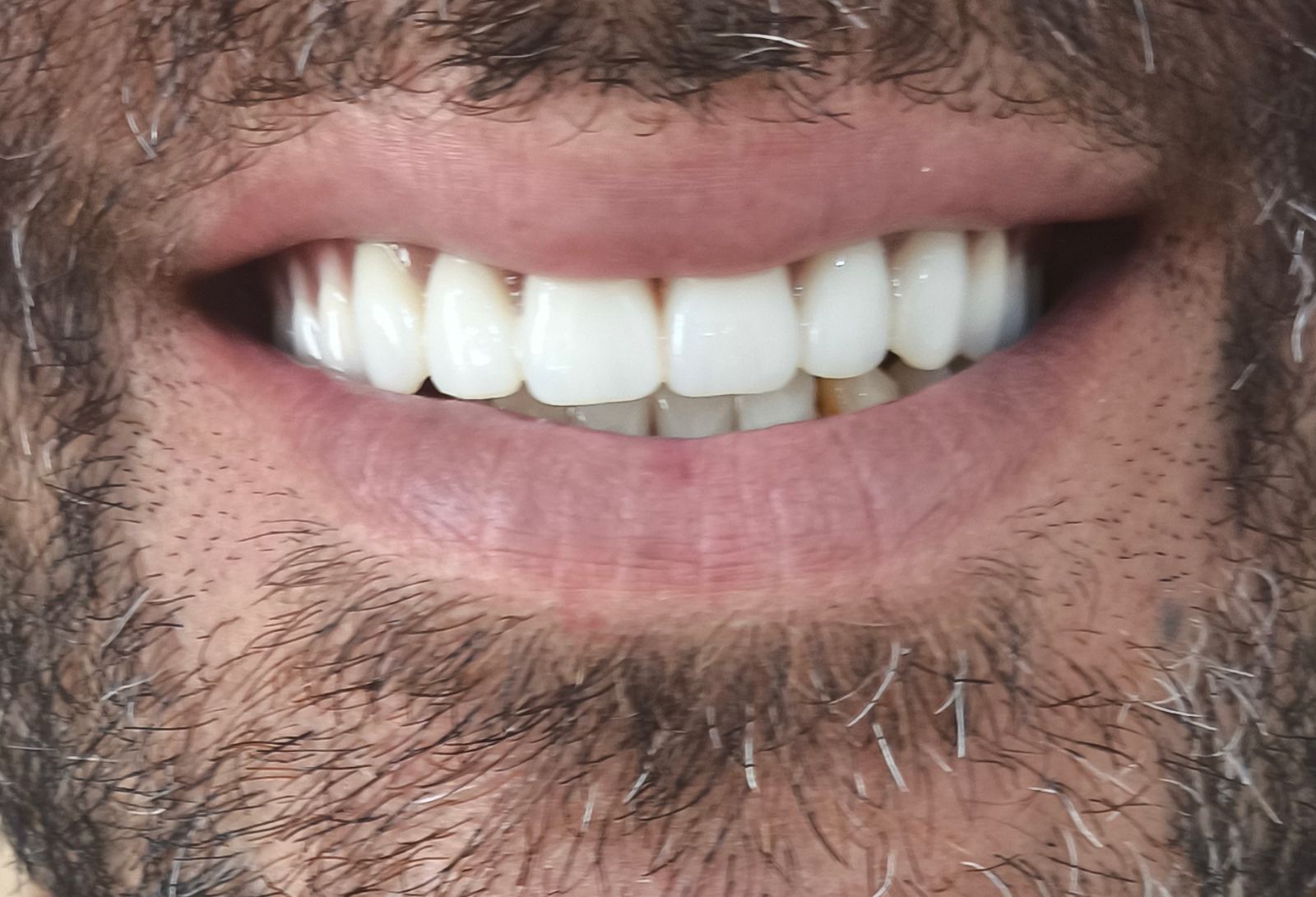 دندانسازی الماس