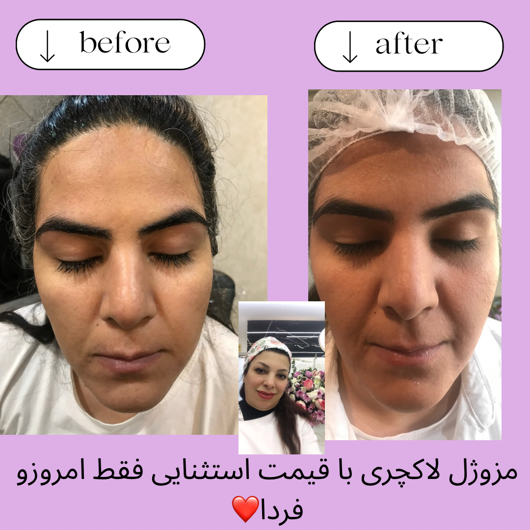 حجامت،بادکش،زالو،فصد (غلامی)