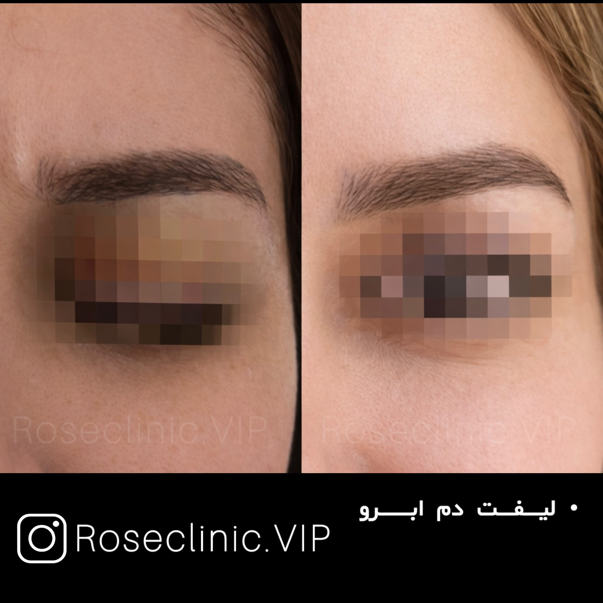 کلینیک تخصصی زیبایی رز - فیلر بوتاکس