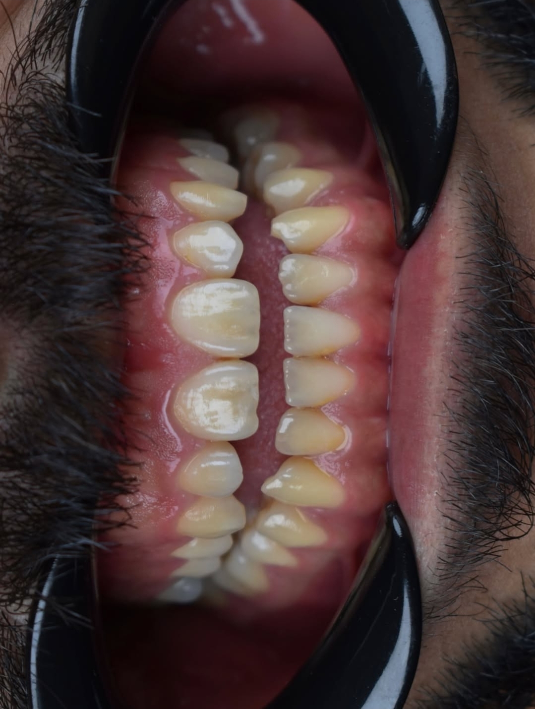 خدمات تخصصی ایمپلنت و لمینت دن